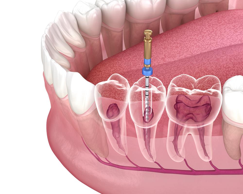 Root canal treatment and tooth pain evaluation at Flex Dental in Tampa