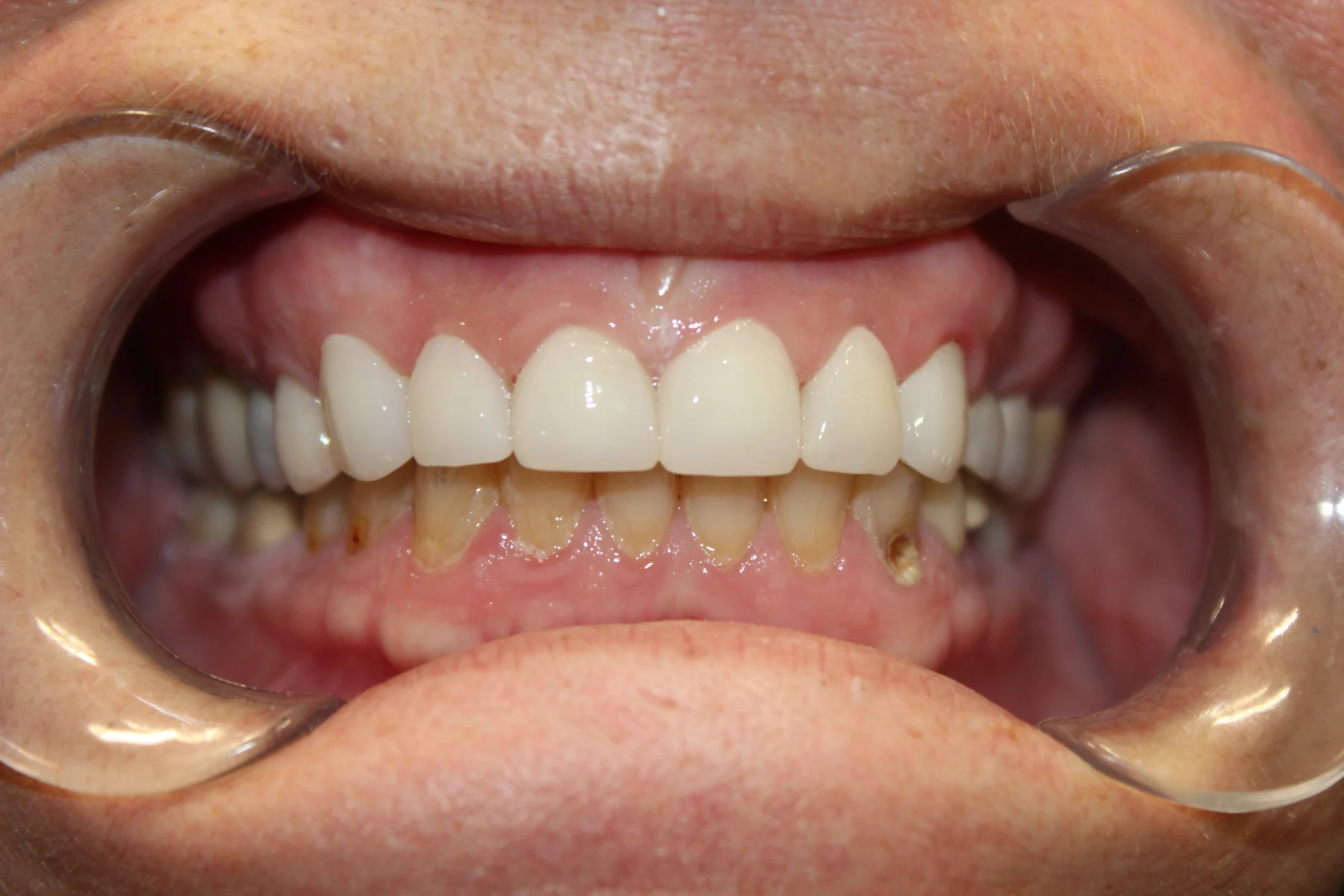 Patient smile after cosmetic dental treatment at Flex Dental in Tampa