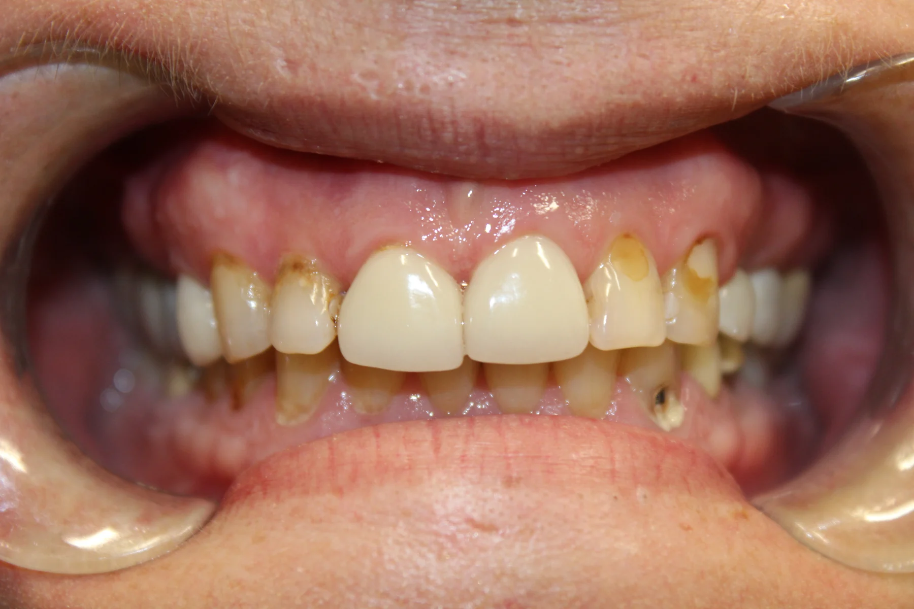 Patient smile before cosmetic dental treatment at Flex Dental in Tampa