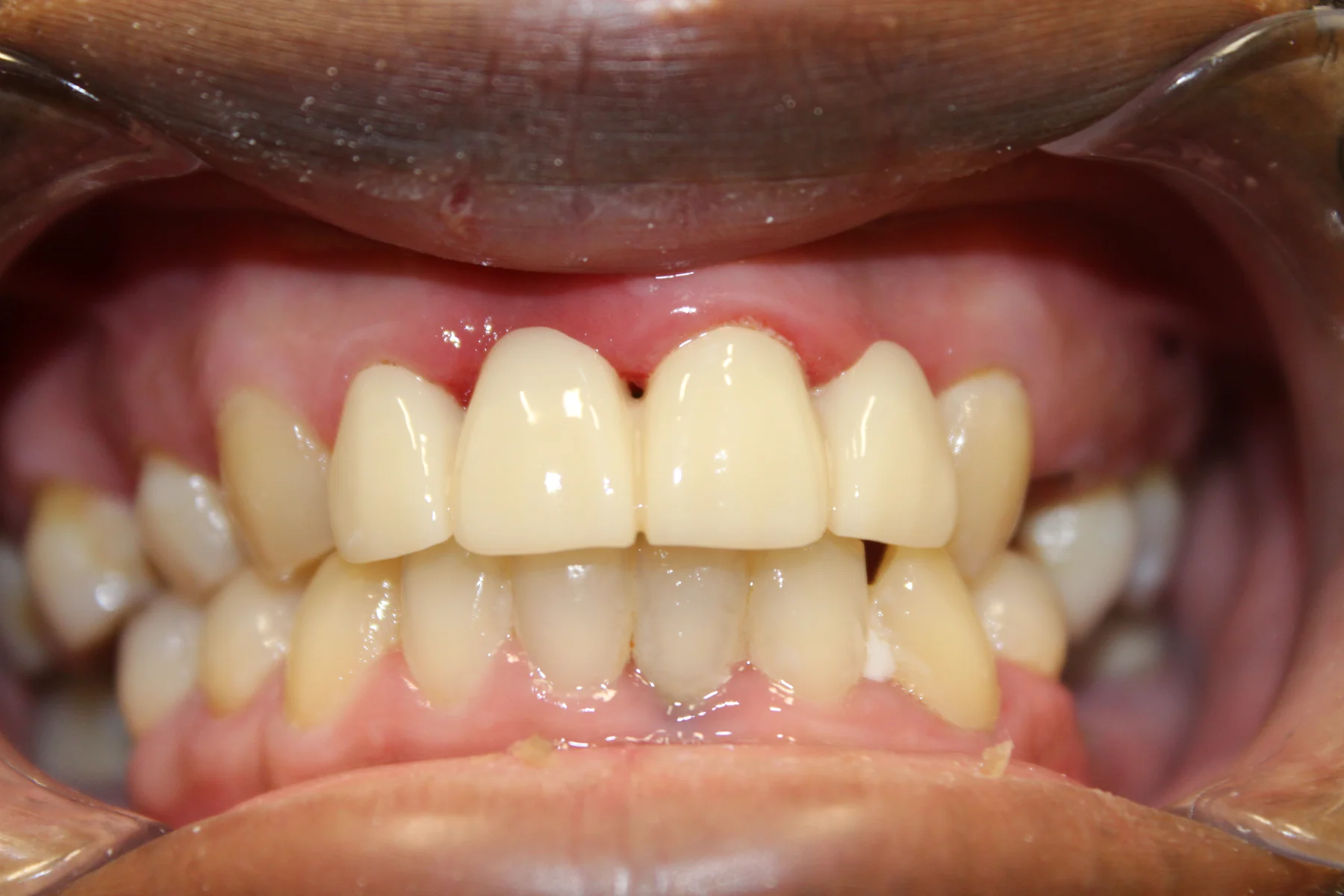 Second patient smile after cosmetic dental care at Flex Dental