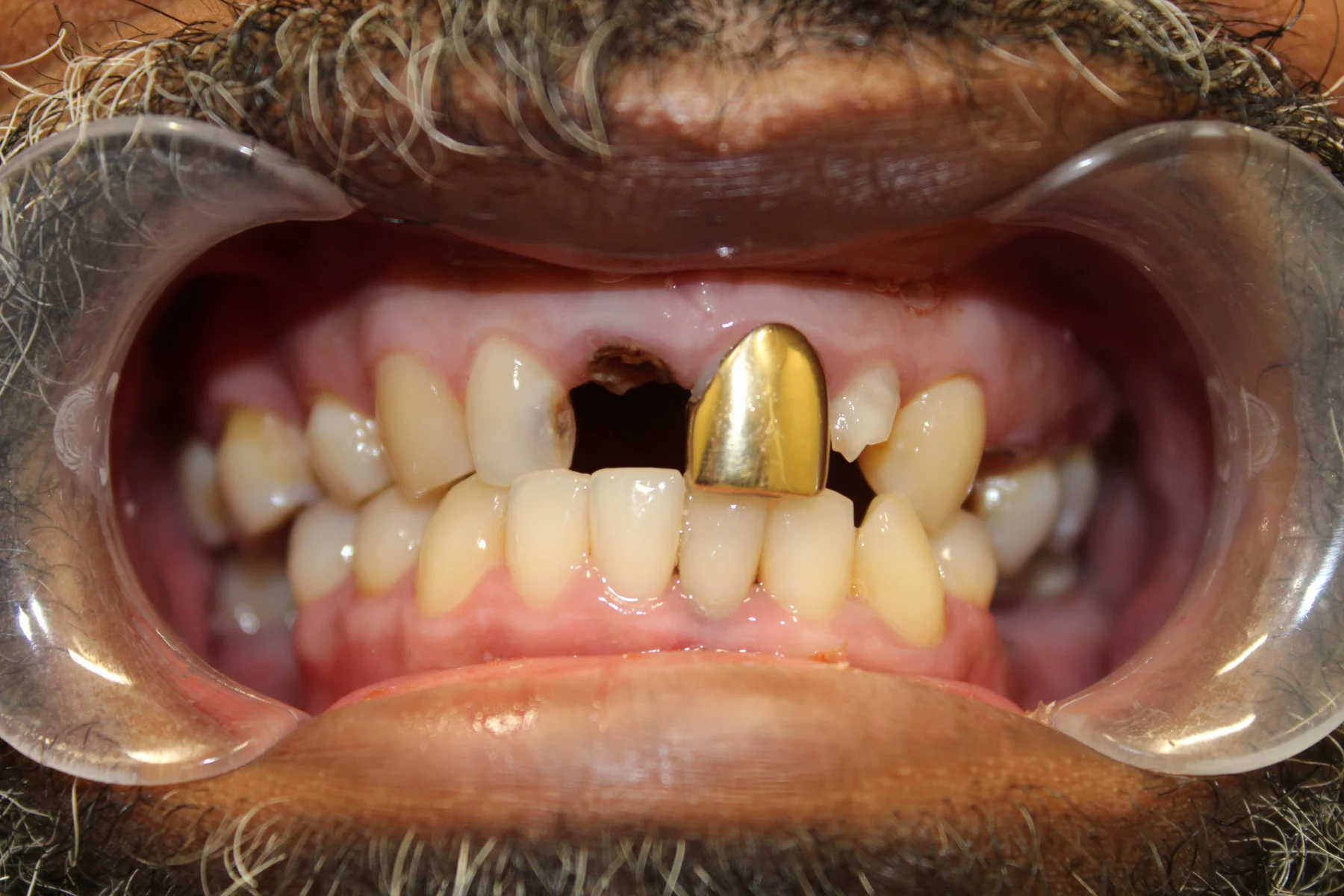 Second patient smile before cosmetic dental care at Flex Dental