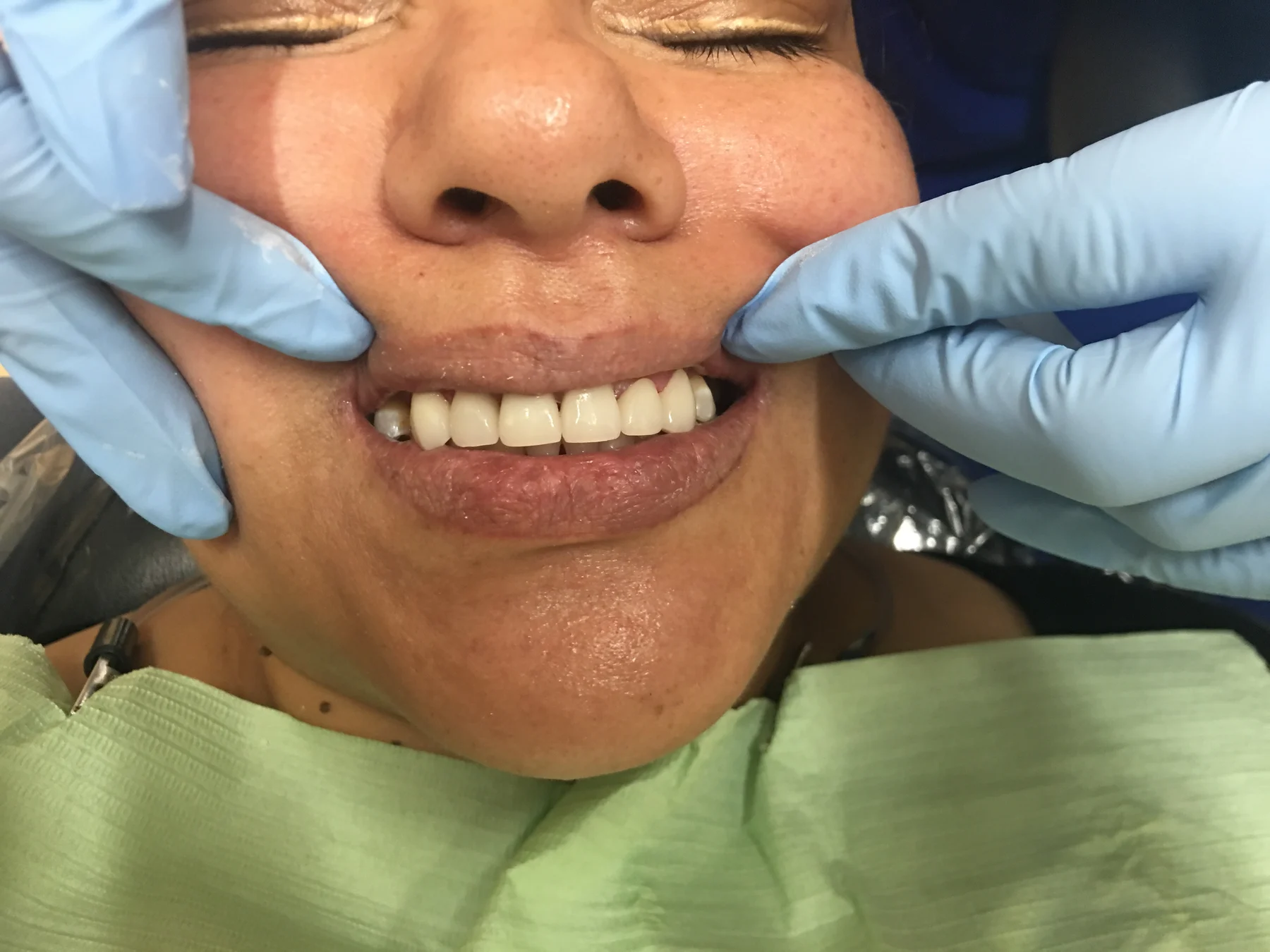 Third patient smile after cosmetic dentistry in Tampa