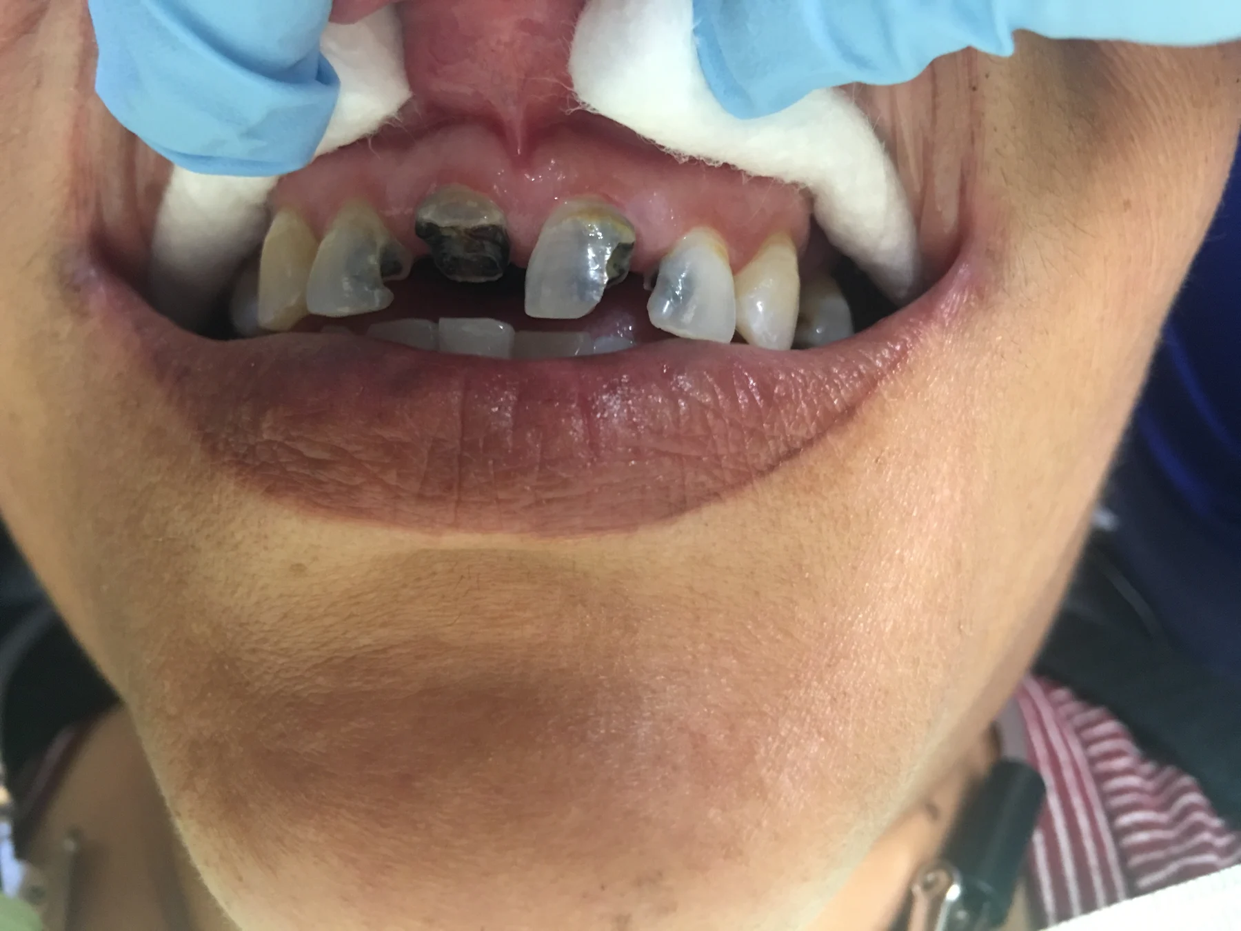 Third patient smile before cosmetic dentistry in Tampa